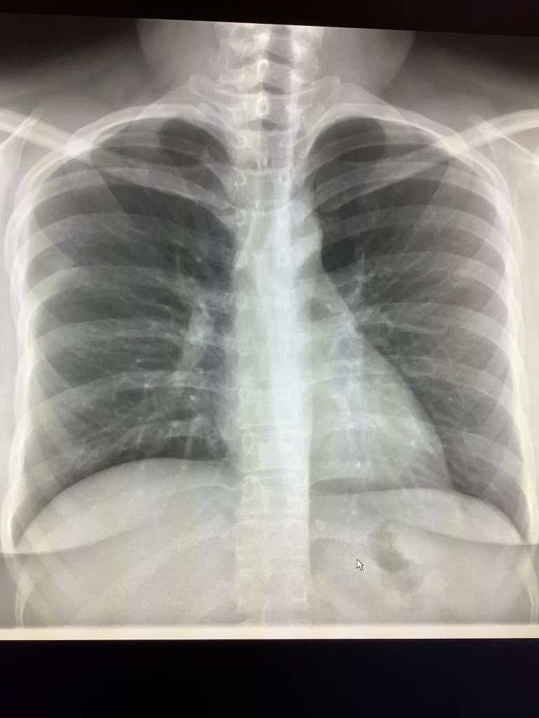 Chest X-Ray Clear But Still Have Symptoms