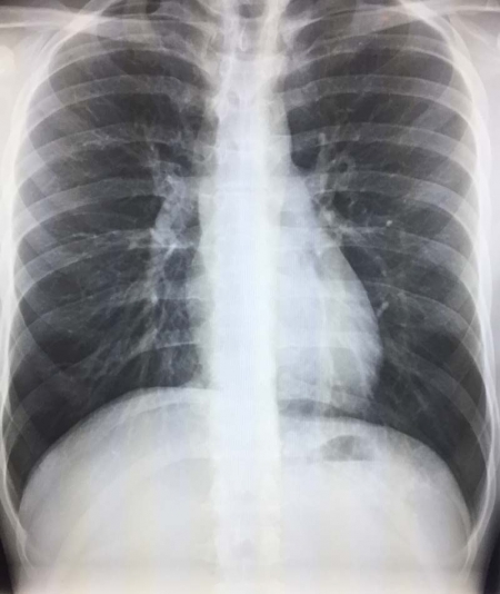 Granuloma Chest X Ray