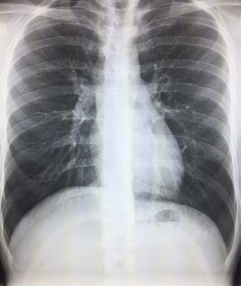 Calcified Granuloma On Chest X-Ray