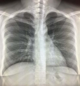 lung nodule on chest x ray