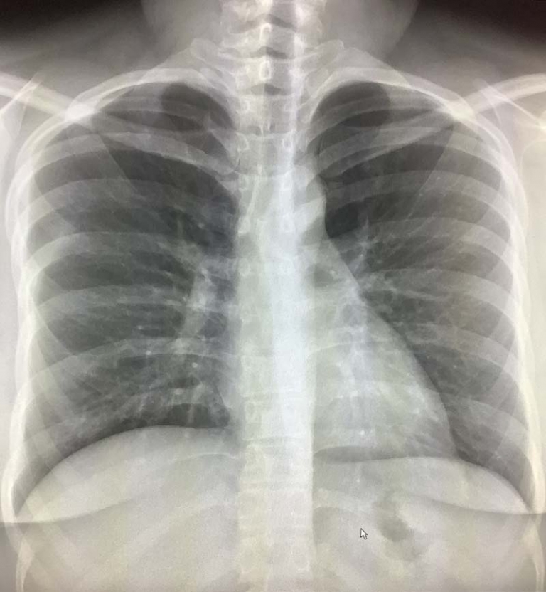 Lung Nodule Under One Centimeter On Chest XRay