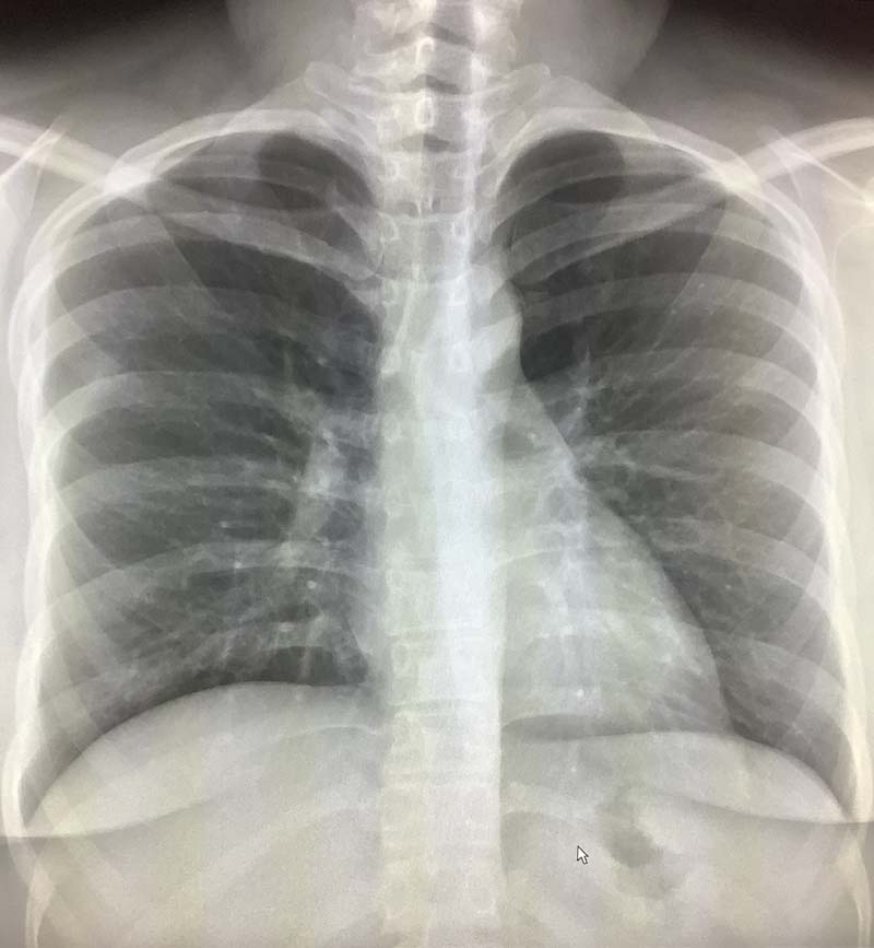 normal lung xray