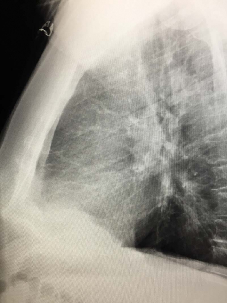 Ground Glass Opacities In Lungs – Radiology In Plain English