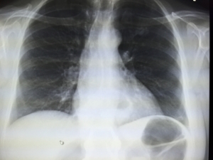 atelectasis subsegmental lung radiology represent