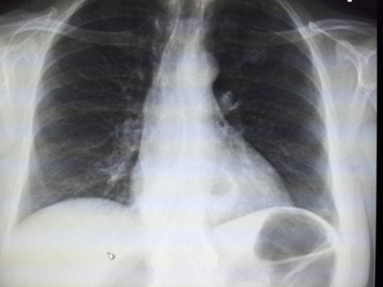Subsegmetal Atelectasis On Chest X-Ray