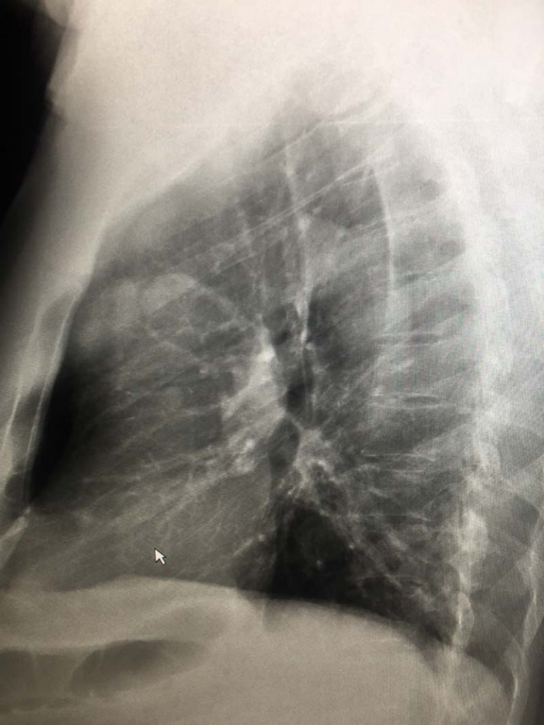 Widened Mediastinum On A Chest X-Ray