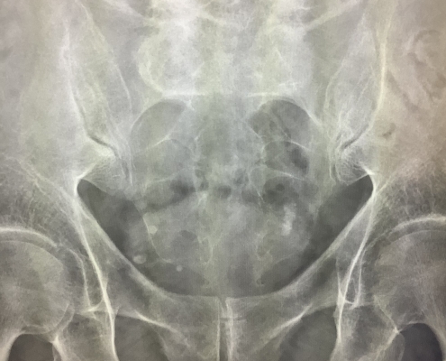 calcifications pelvis ray small