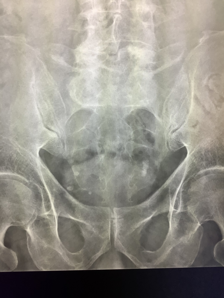 Small Calcifications In The Pelvis On X-Ray