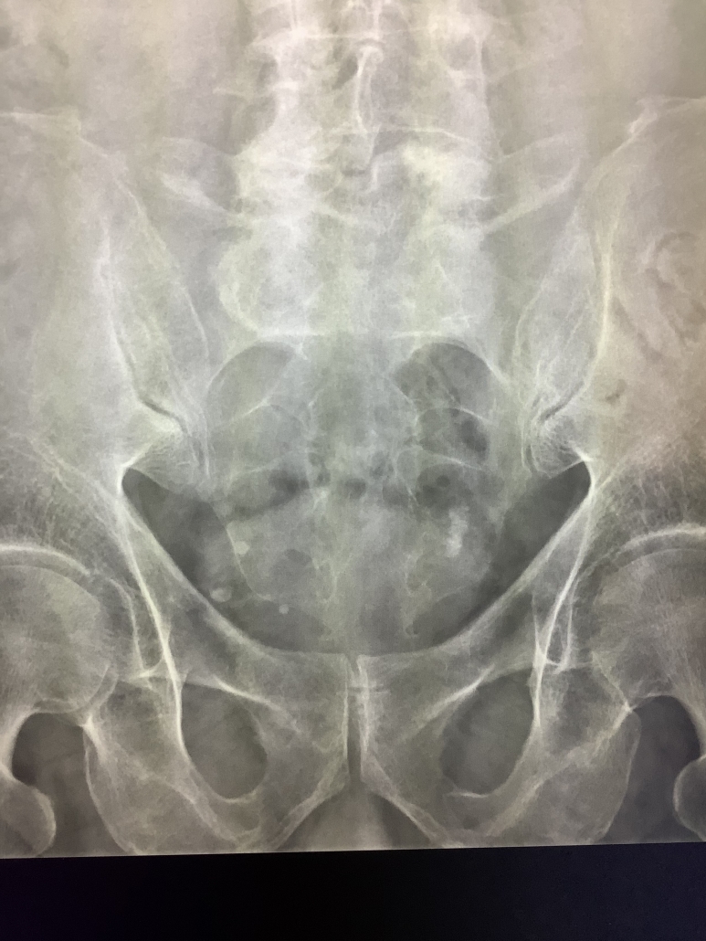 Pelvis X Ray Labelled