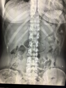 non specific bowel gas pattern
