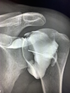 shoulder arthogram