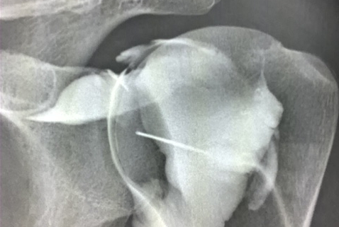 arthrogram