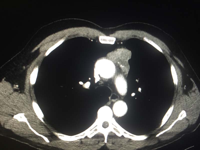 anterior-mediastinal-mass-on-ct-radiology-in-plain-english