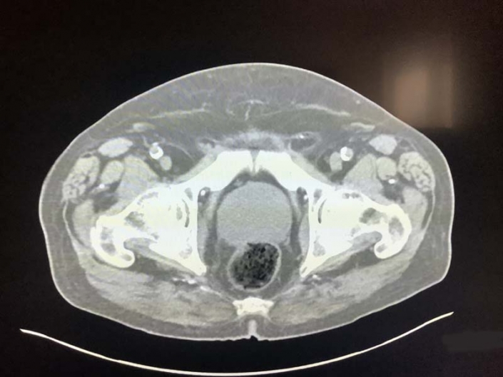 Enlarged Prostate On Ct – Radiology In Plain English