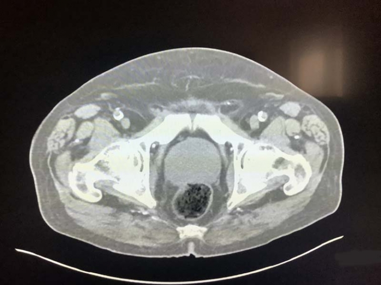 Enlarged Prostate On CT