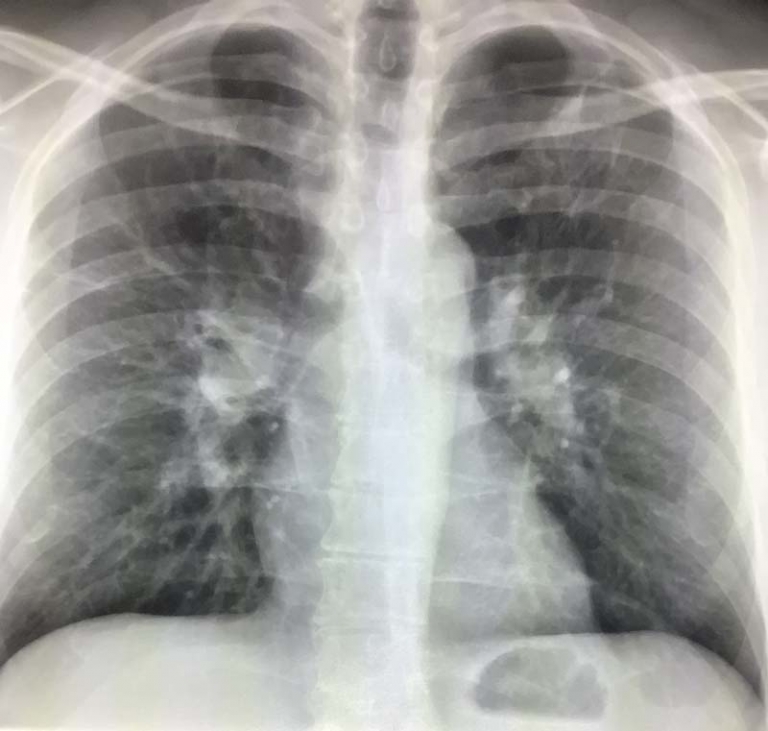 Bilateral Hilar Prominence On Chest X-Ray