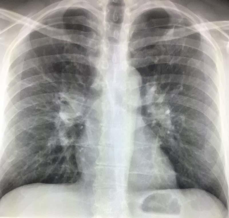 bilateral-hilar-prominence-on-chest-x-ray-radiology-in-plain-english