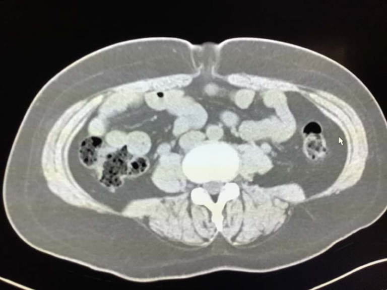 Umbilical Hernia on CT