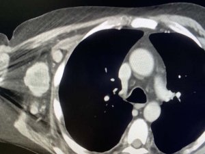 Enlarged Axillary lymph nodes on CT