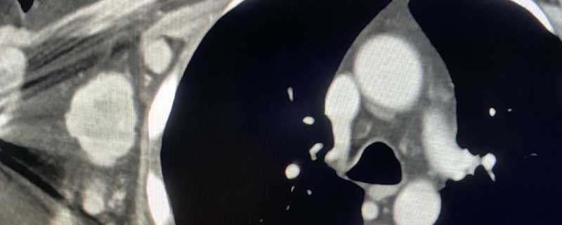 Enlarged Lymph Nodes On One Side On CT – Radiology In Plain English