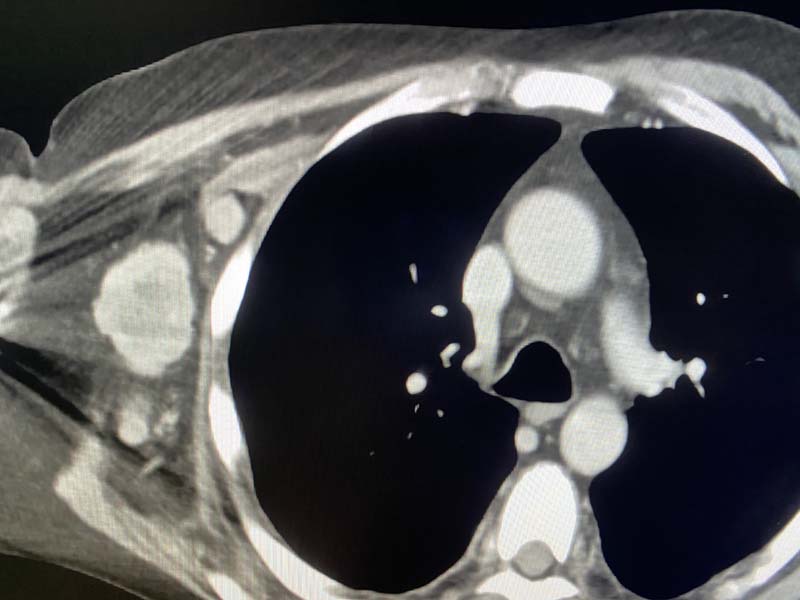 Enlarged Lymph Nodes In The Armpit Axilla On One Side On Ct