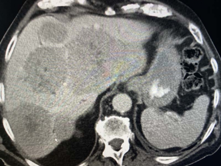 Liver Masses On CT Scan