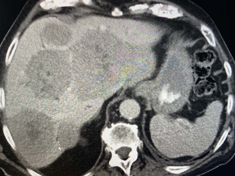 Liver Mass Ct Scan