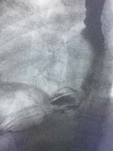 Small hiatal hernia on esophogram