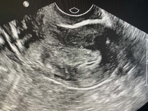 Thickened endometrium on ultrasound