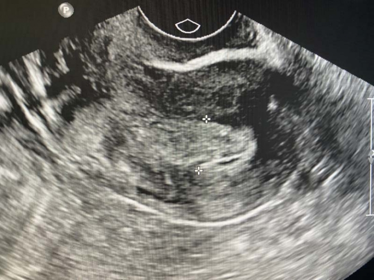 Thickened Endometrium On Ultrasound in a Post Menopausal Patient
