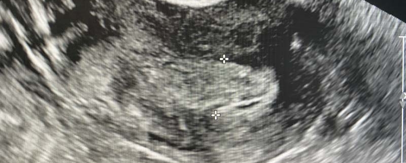 thickened-endometrium-on-ultrasound-in-a-post-menopausal-radiology-in