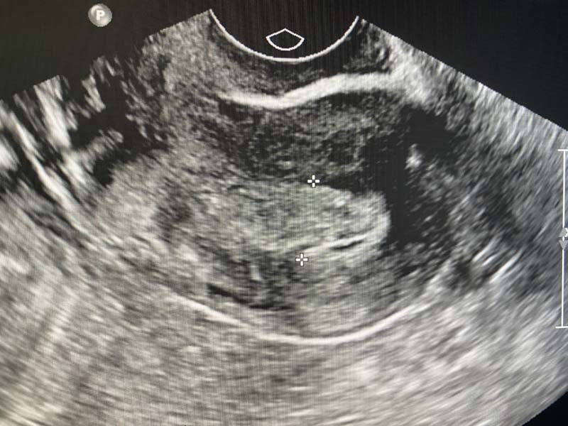 Endometrial Cysts On Ultrasound