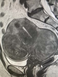 Uterine fibroids on MRI