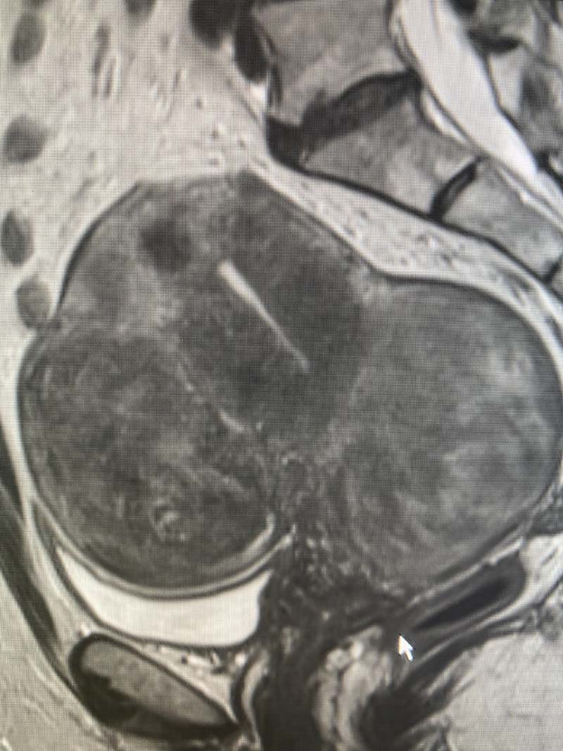 Uterine Fibroids on Ultrasound – Radiology In Plain English