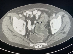 Ulcerative Colitis On CT Scan